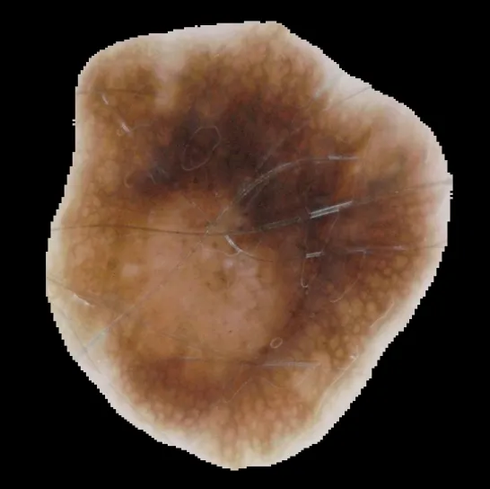 Screenshot of Skin Lesion Segmentation with U-Net project